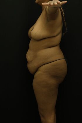Liposuction: Case 45 - Before