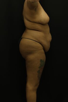 Liposuction: Case 45 - Before