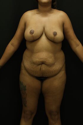 Liposuction Case 45 - Before