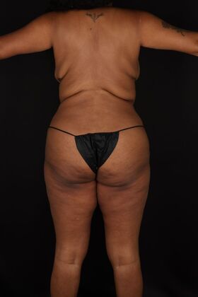 Liposuction: Case 45 - After