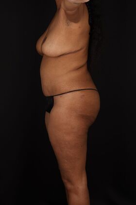 Liposuction: Case 45 - After