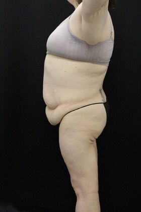 Tummy Tuck: Case 91 - Before