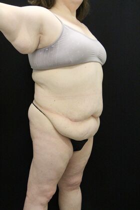 Tummy Tuck Case 91 - Before