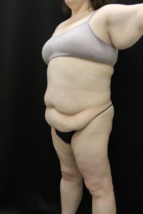 Tummy Tuck: Case 91 - Before