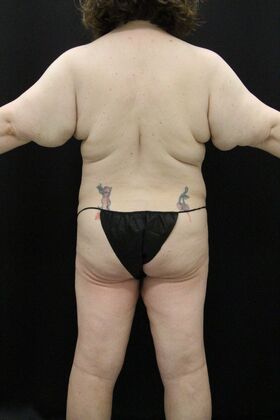 Tummy Tuck: Case 91 - Before