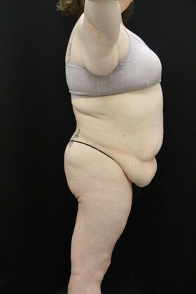 Tummy Tuck: Case 91 - Before