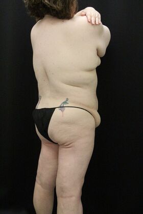 Tummy Tuck: Case 91 - Before