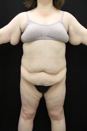 Tummy Tuck: Case 91 - Before