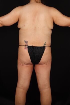 Tummy Tuck: Case 91 - After