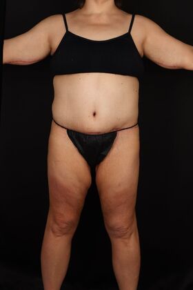 Tummy Tuck: Case 91 - After