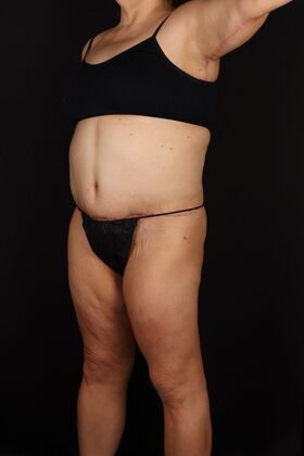 Tummy Tuck: Case 91 - After