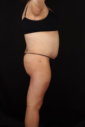 Tummy Tuck: Case 91 - After
