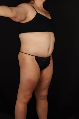 Tummy Tuck Case 91 - After
