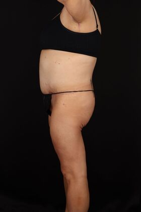 Tummy Tuck: Case 91 - After