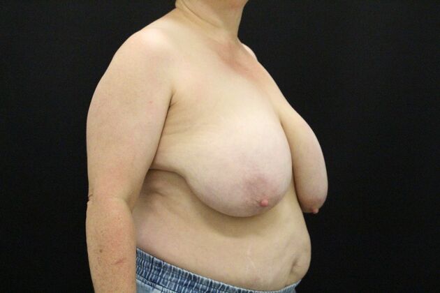 Breast Reduction & Lift: Case 44 - Before