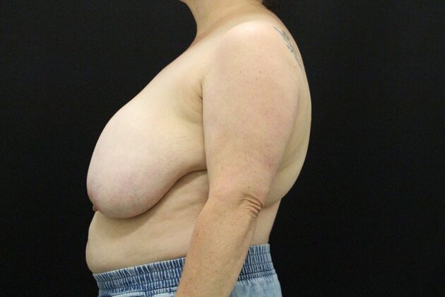 Breast Reduction & Lift: Case 44 - Before