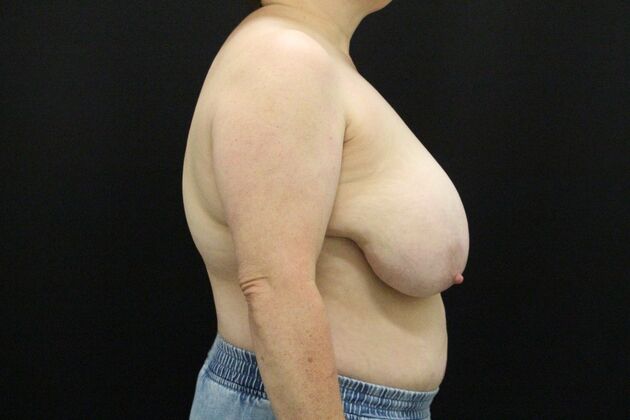 Breast Reduction & Lift: Case 44 - Before
