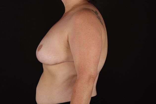 Breast Reduction & Lift: Case 44 - After