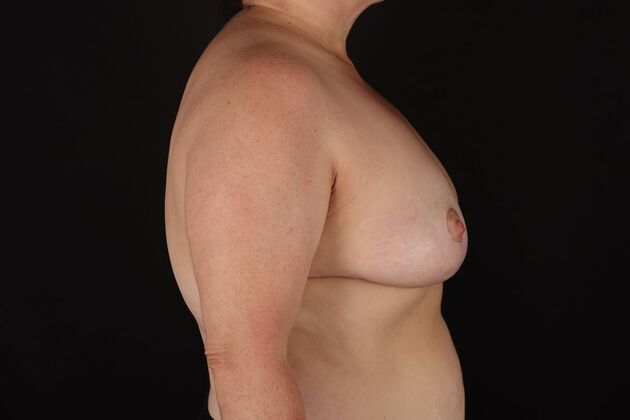 Breast Reduction & Lift: Case 44 - After
