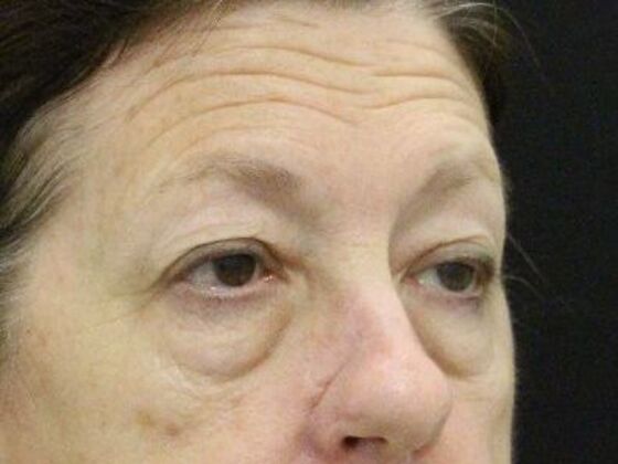 Eyelid Surgery: Case 4 - Before