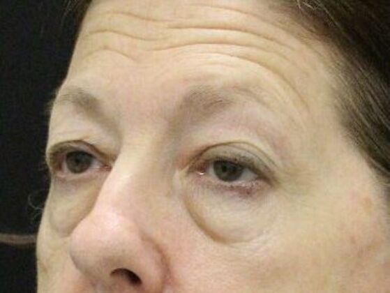 Eyelid Surgery: Case 4 - Before