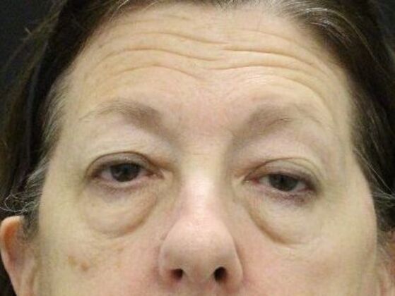 Eyelid Surgery Case 4 - Before