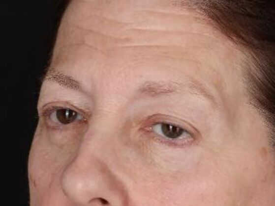 Eyelid Surgery: Case 4 - After