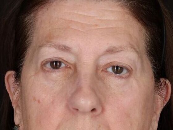 Eyelid Surgery Case 4 - After