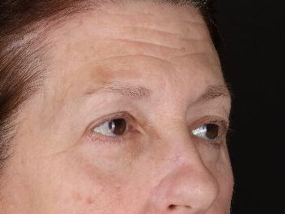 Eyelid Surgery: Case 4 - After