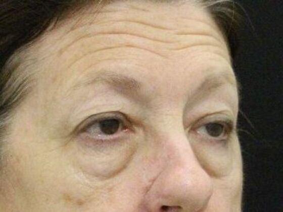 Brow Lift: Case 3 - Before