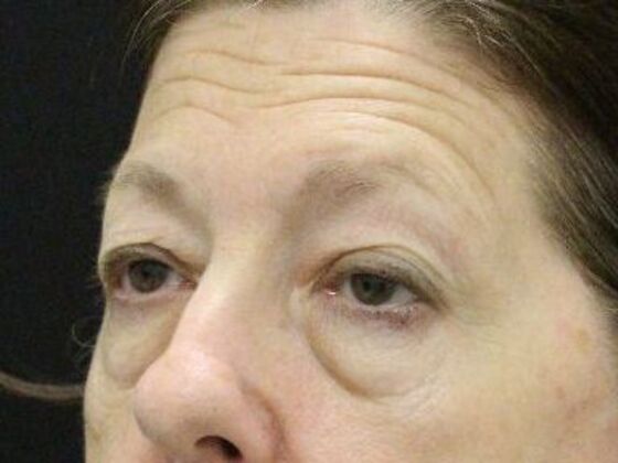Brow Lift: Case 3 - Before