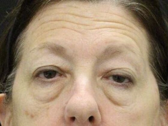 Brow Lift Case 3 - Before