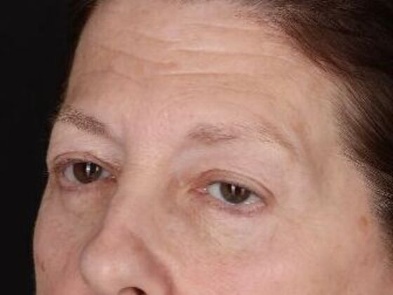 Brow Lift: Case 3 - After
