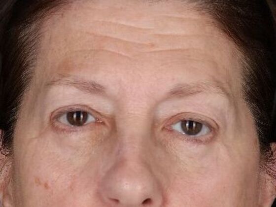 Brow Lift Case 3 - After