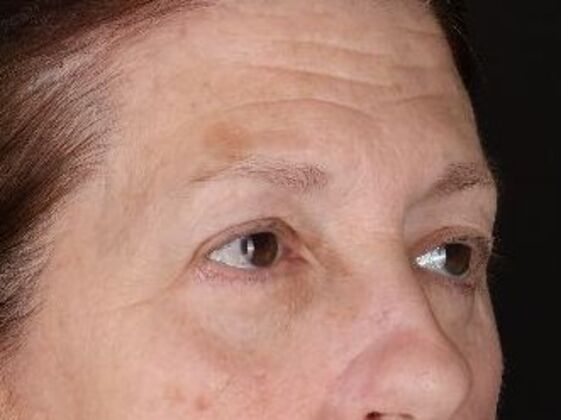 Brow Lift: Case 3 - After