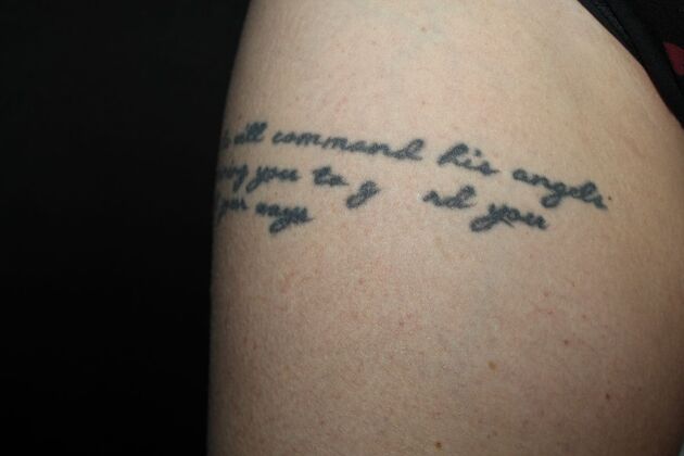 Laser Tattoo Removal Case 48 - After