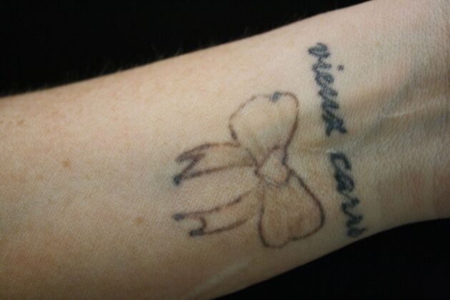 Laser Tattoo Removal Case 49 - Before