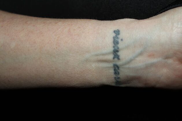 Laser Tattoo Removal Case 49 - After