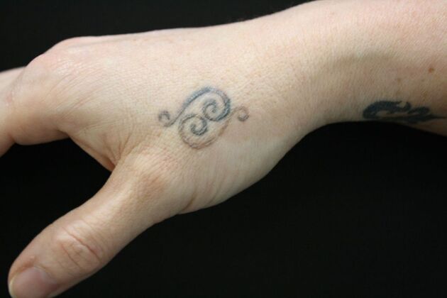 Laser Tattoo Removal Case 50 - Before