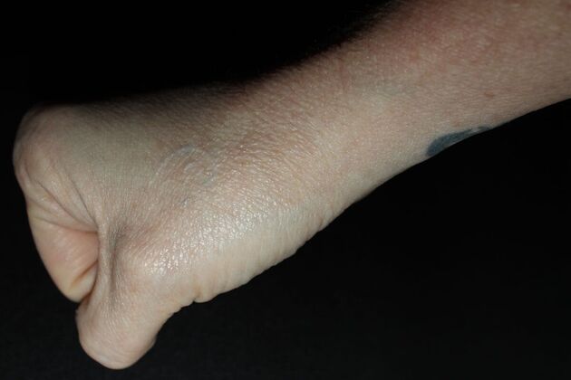 Laser Tattoo Removal Case 50 - After