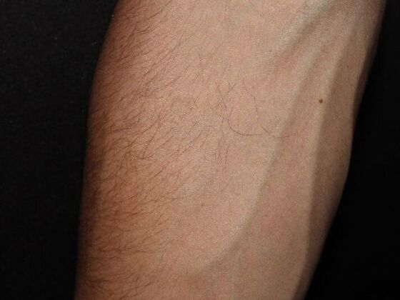 Laser Tattoo Removal Case 51 - After