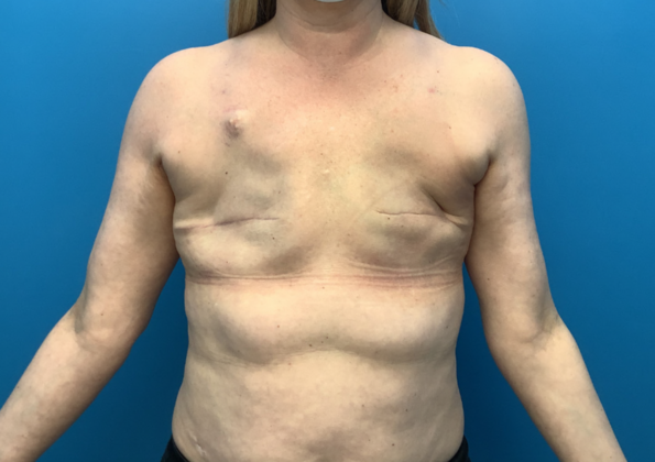 Breast Reconstruction After Traditional Mastectomy: Case 2 - After double mastectomy and radiation treatment to left side