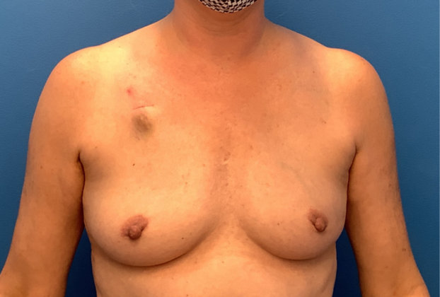 Breast Reconstruction After Traditional Mastectomy Case 2 - Before