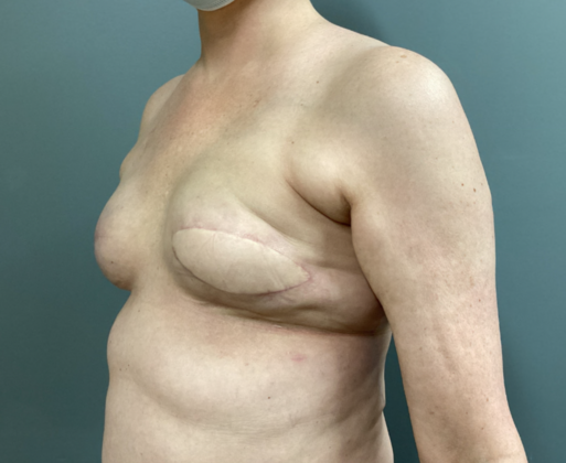 Breast Reconstruction After Traditional Mastectomy: Case 2 - left breast is reconstructed with a tissue expander and latissimus flap