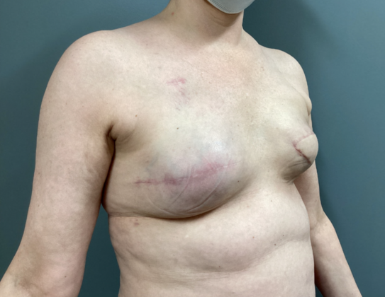 Breast Reconstruction After Traditional Mastectomy: Case 2 - Right breast is reconstructed with a tissue expander