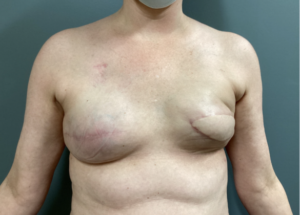 Breast Reconstruction After Traditional Mastectomy: Case 2 - Expanders filled to 360cc