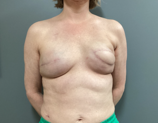 Breast Reconstruction After Traditional Mastectomy: Case 2 - 3 months after surgery