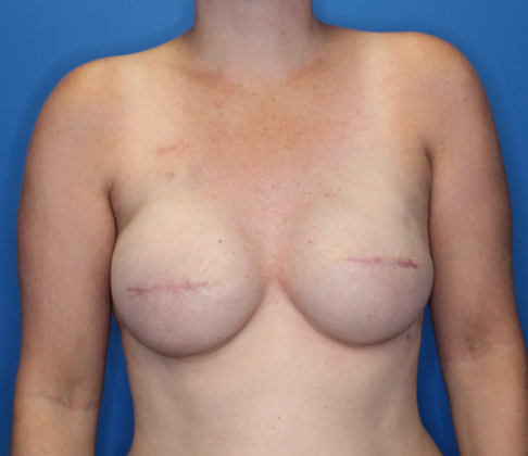 Breast Reconstruction After Traditional Mastectomy: Case 1 - 6 months after 2nd surgery: Breast implants upsized (495cc) and fat grafting to breast skin