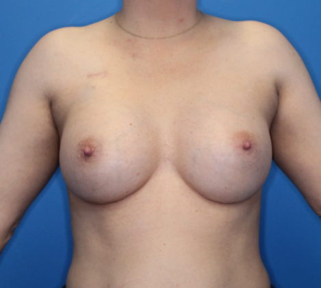 Breast Reconstruction After Traditional Mastectomy Case 1 - Before