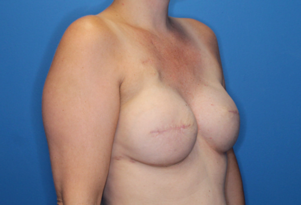 Breast Reconstruction After Traditional Mastectomy: Case 1 - 6 months after 2nd surgery: Breast implants upsized (495cc) and fat grafting to breast skin